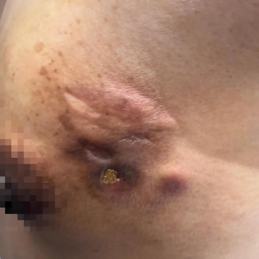 After treatment: wounds fully healed with only mild residual pigmentation, and chest wall rash largely resolved on the right side