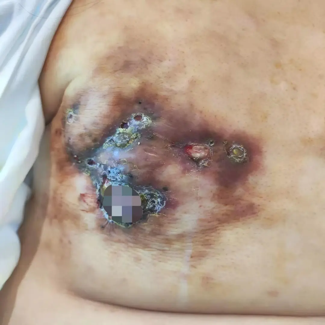 Before treatment: ulcerated primary breast lesions and metastatic chest wall skin damage on the left side