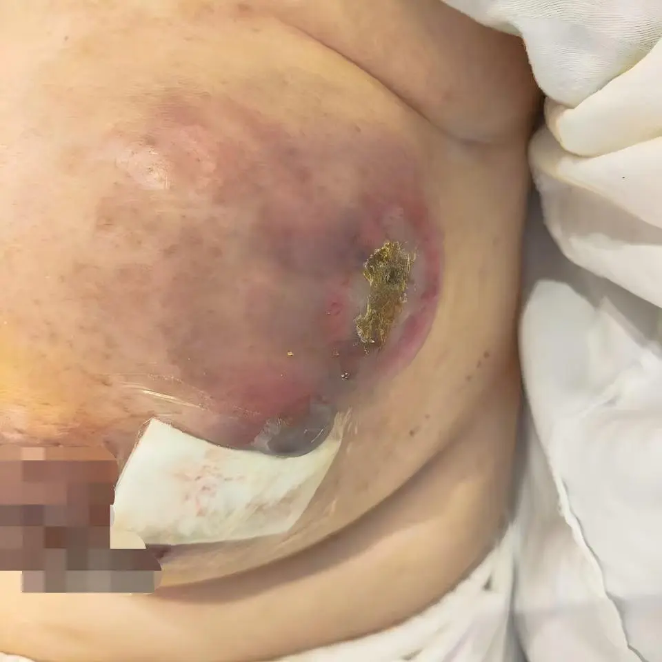 Before treatment: ulcerated primary breast lesions and metastatic chest wall skin damage on the right side