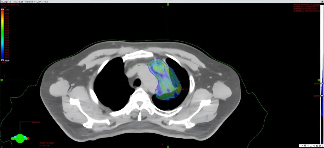 Adaptive replanned proton treatment showing restored target dose coverage
