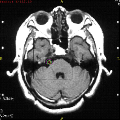 High-resolution MRI scan used for Gamma Knife treatment planning — identifying the precise trigeminal nerve root target for radiosurgery